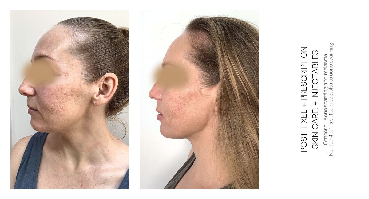 Acne Scarring Before and After 1