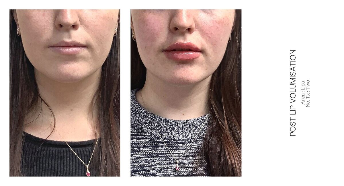 Best South Coast Lip Injection Before and After 48