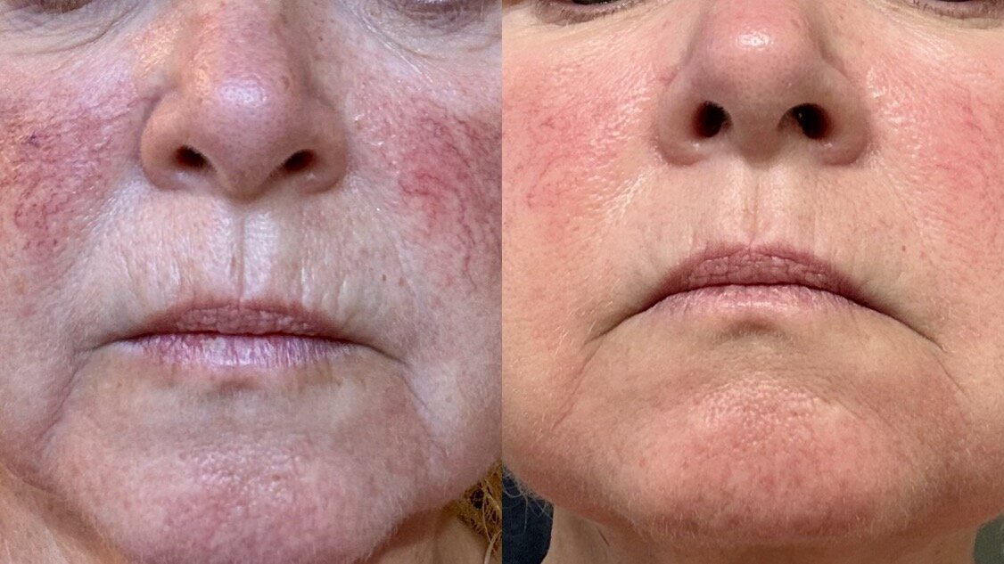 one candela nordlys ipl treatment for facial blood vessels