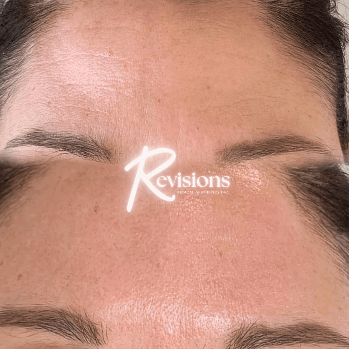 Best_Biorevitalization_Medical_Skin_Collagen_Facial_in_Ottawa (1)