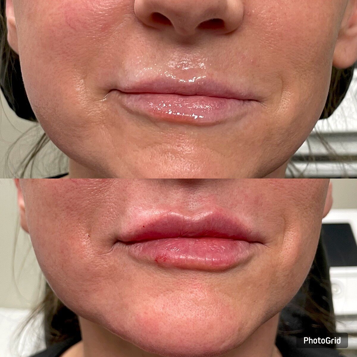 LIP FILLER (1)