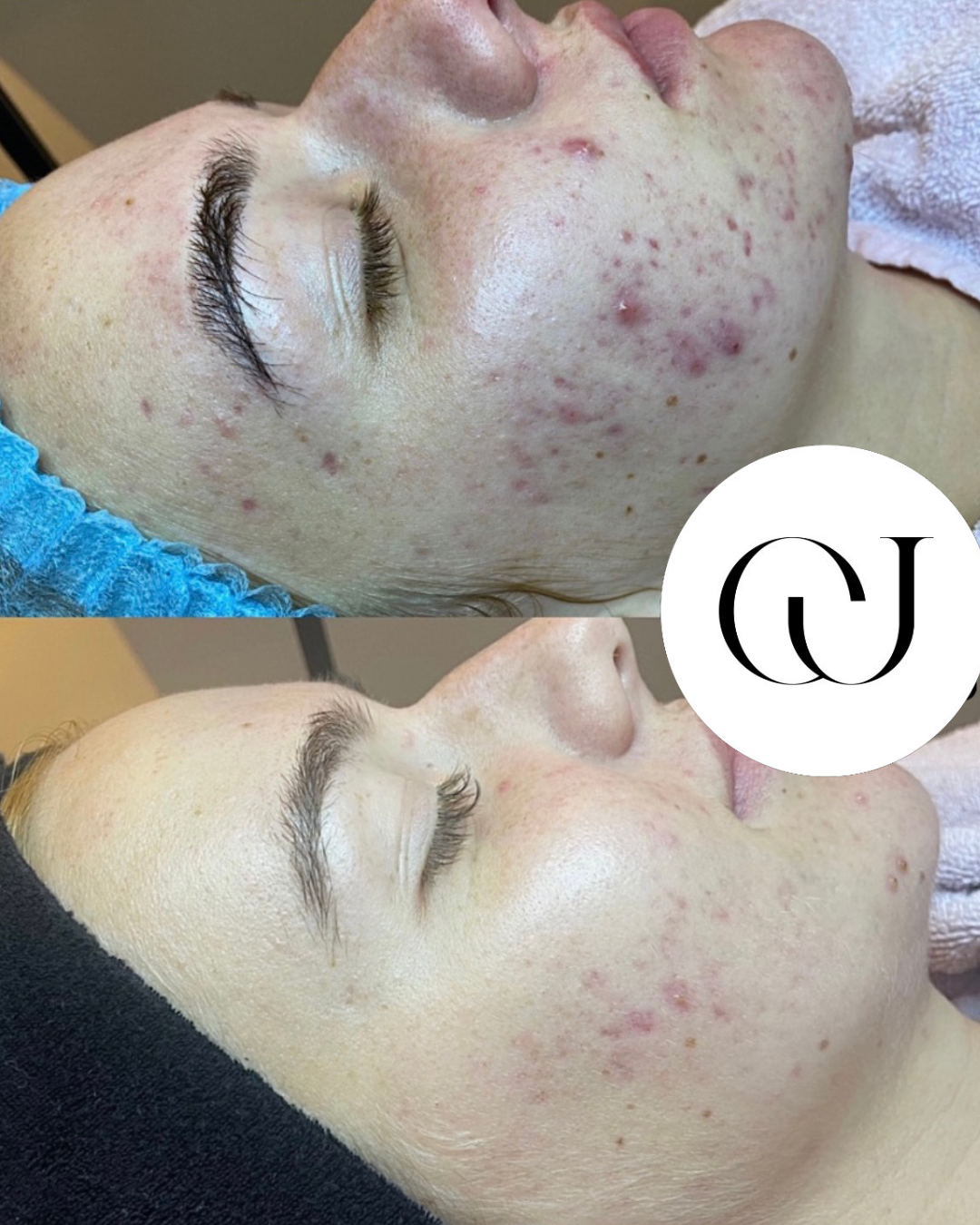 Resultaat Cloud Aesthetics Acne (2)