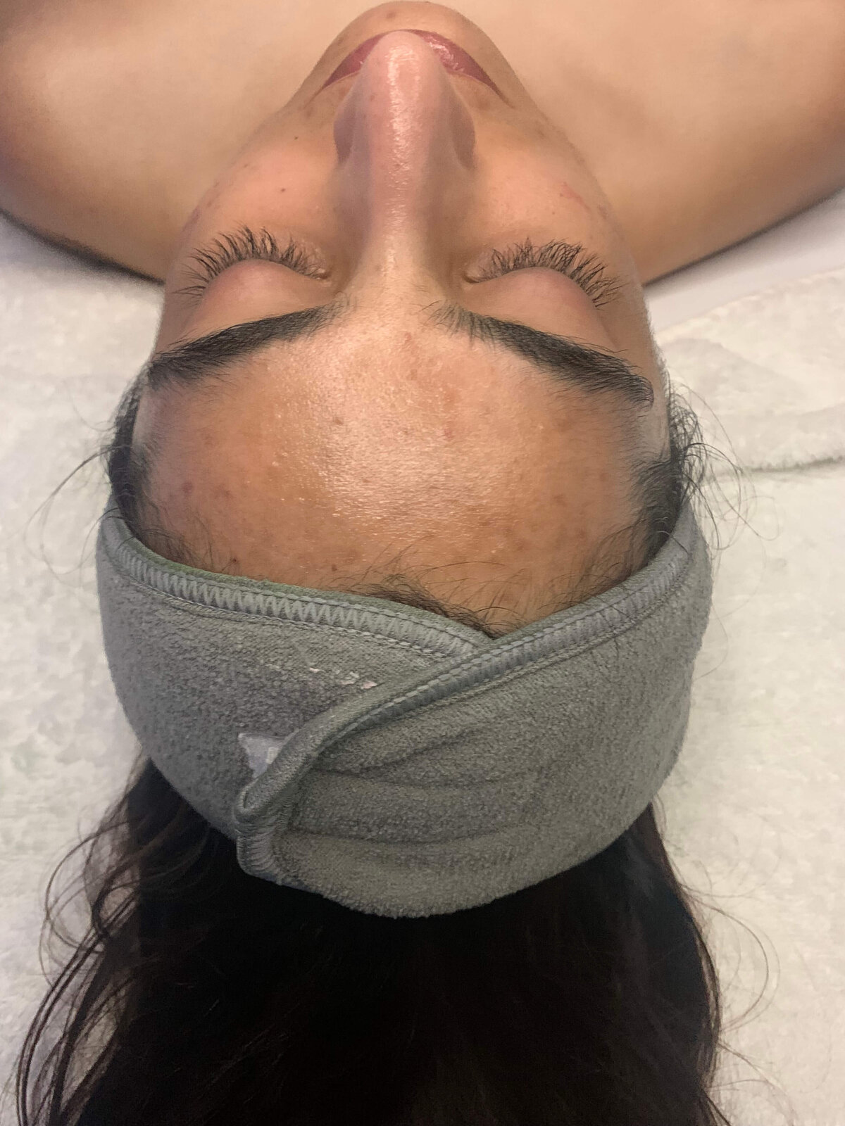 Santa-Barbara-Acne-Specialist_2876