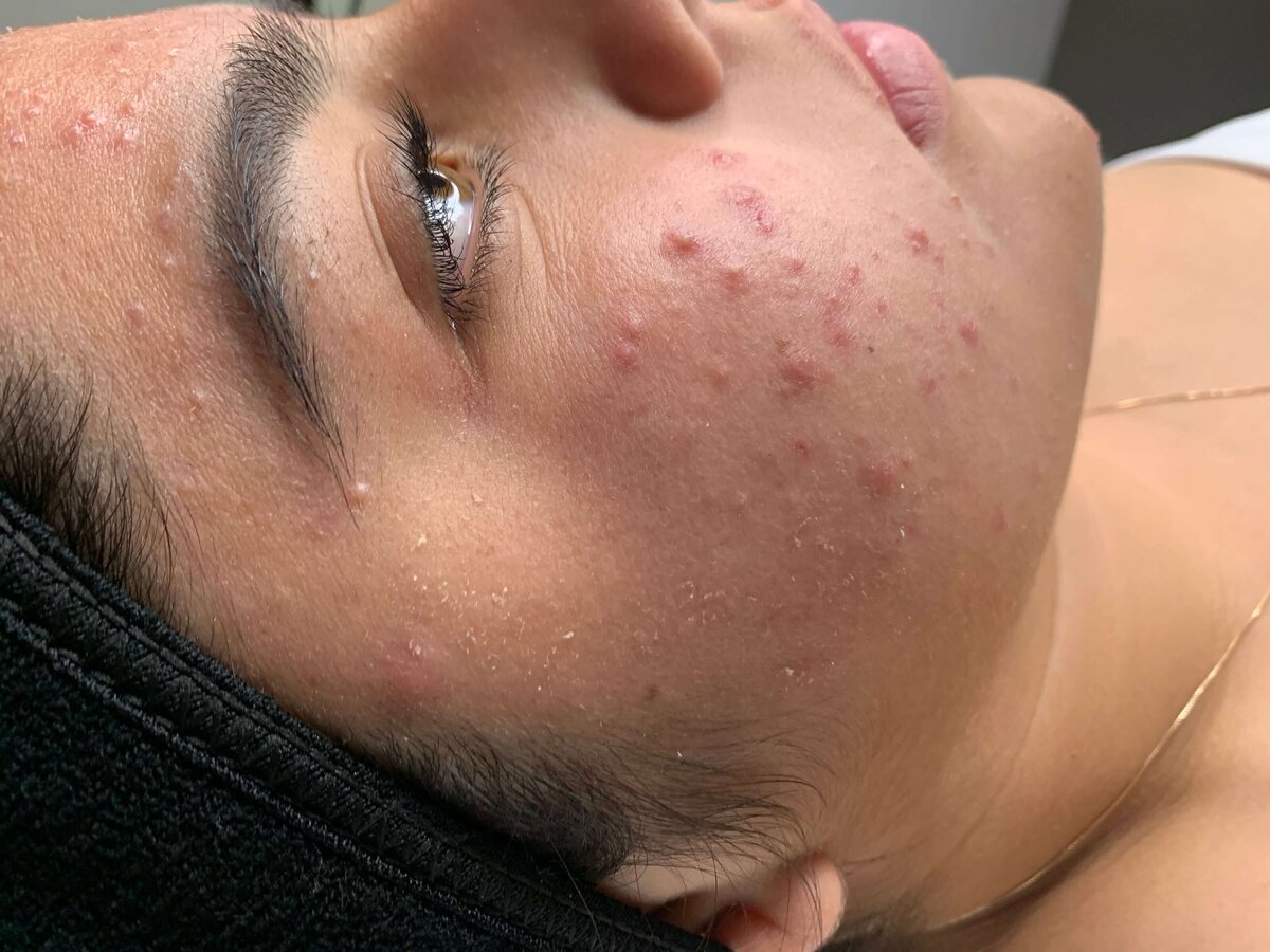 Santa-Barbara-Acne-Specialist_3195