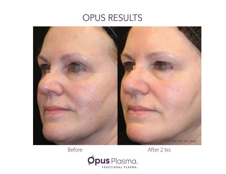 Opus Results Picture 3