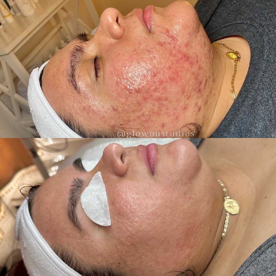 Glow-On-Studios-Before-After-Skincare-Sacramento2