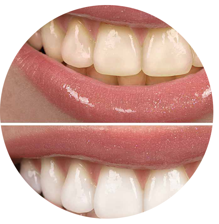 Teeth Whitening Salon l Brownsburg Beauty Bar