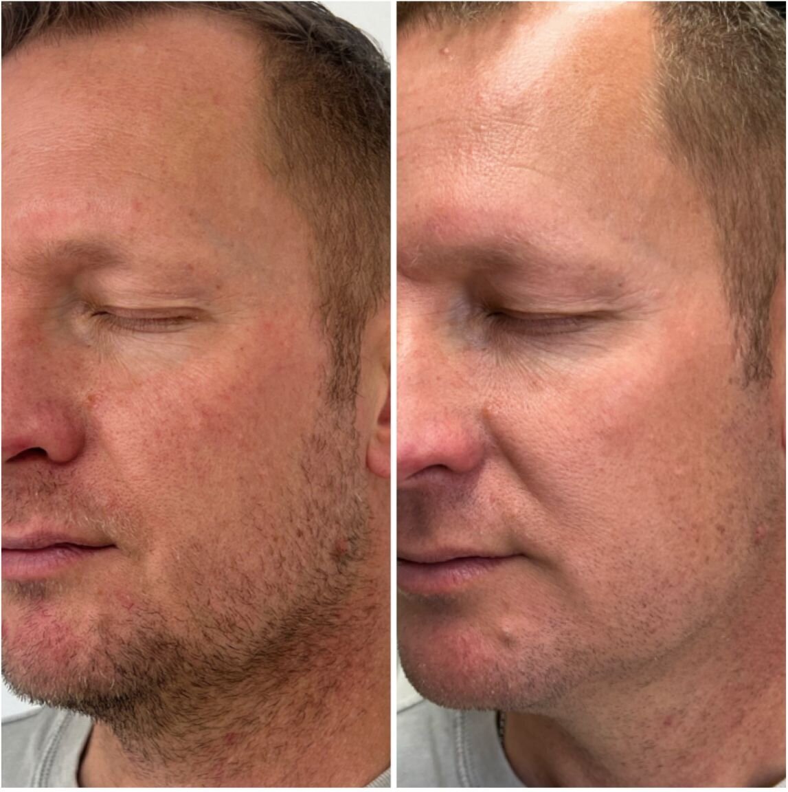 compressed-missing-laser-images-before-after-04