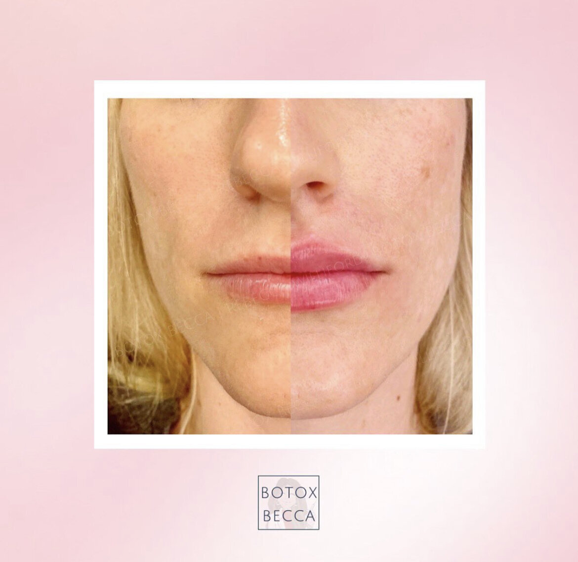 Lip Filler by Rebecca Williford at The Rae Clinic in Augusta, Georgia