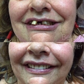 the20day20of20teeth20extraction20surgery20due20to20severe20gum20disease.JPEG