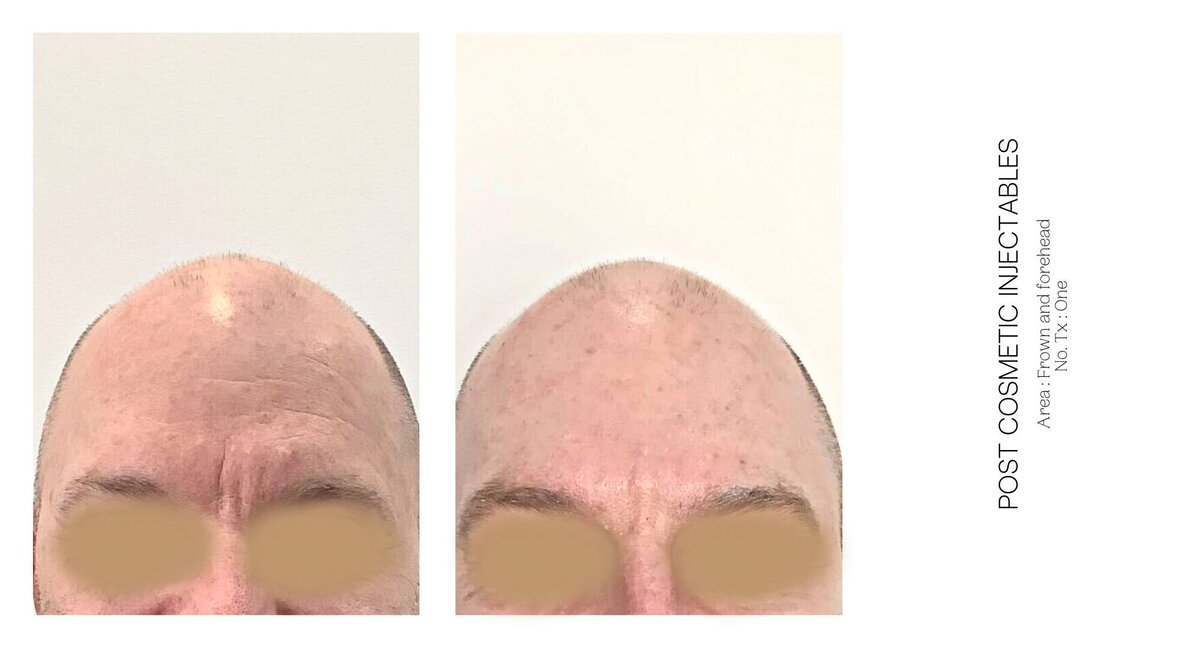 Best Cosmetic Injectable Frown Before and After 2