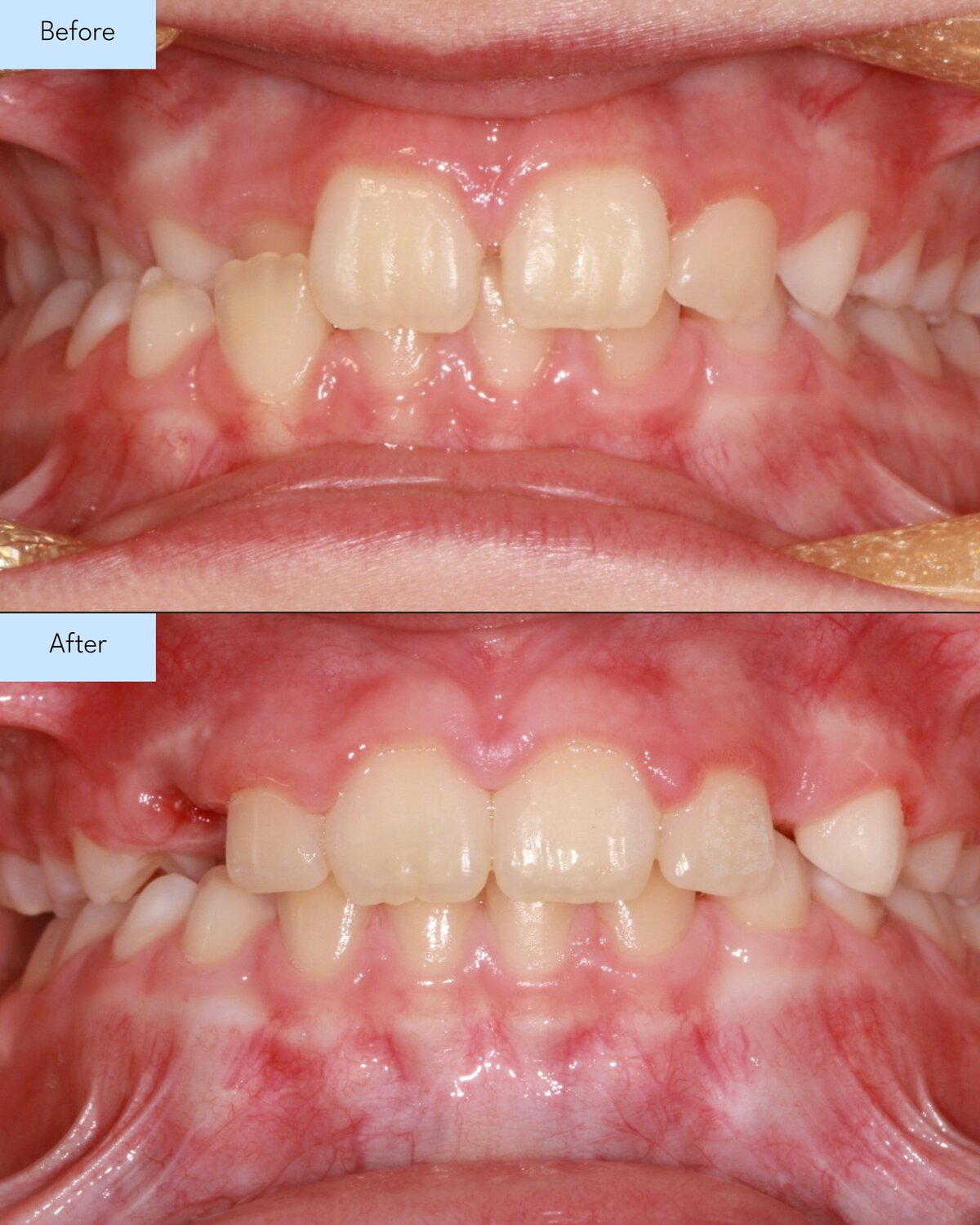 Before and after of Brooks & Templeton Orthodontics patient teeth transformation