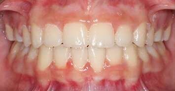 paner smile after braces