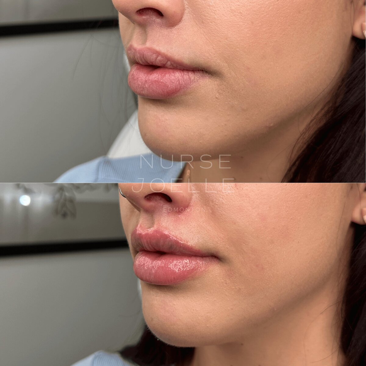 Nurse-Joelle-Cosmetic-Injectables-Before-and-After-11