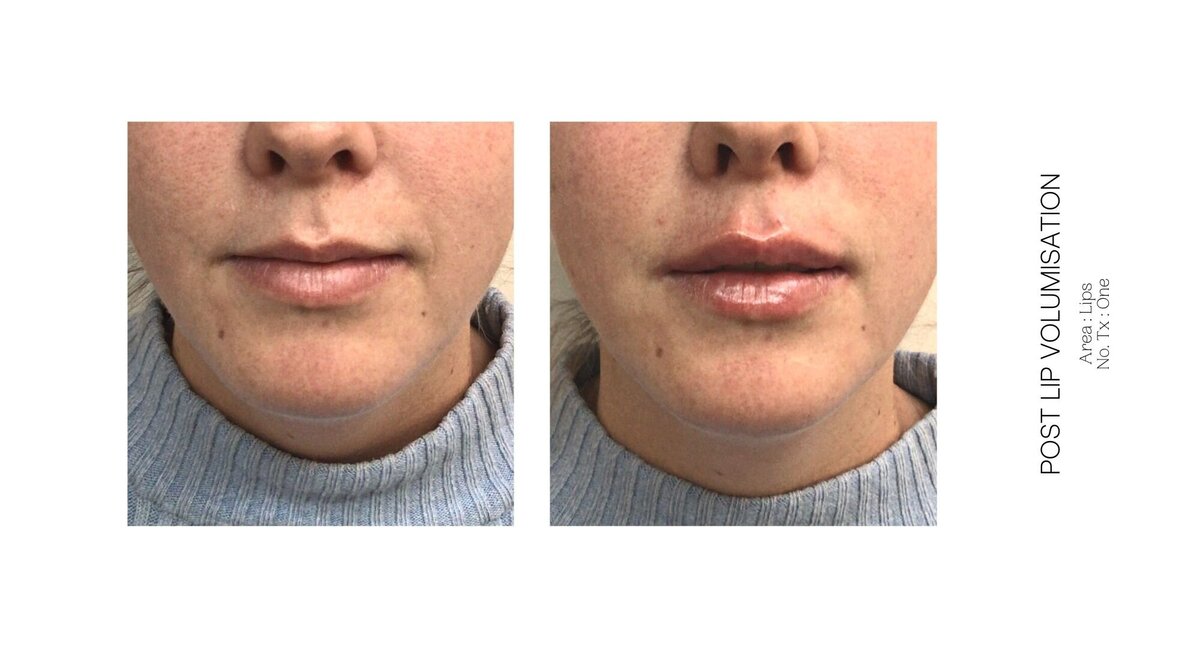 Best South Coast Lip Injection Before and After 38
