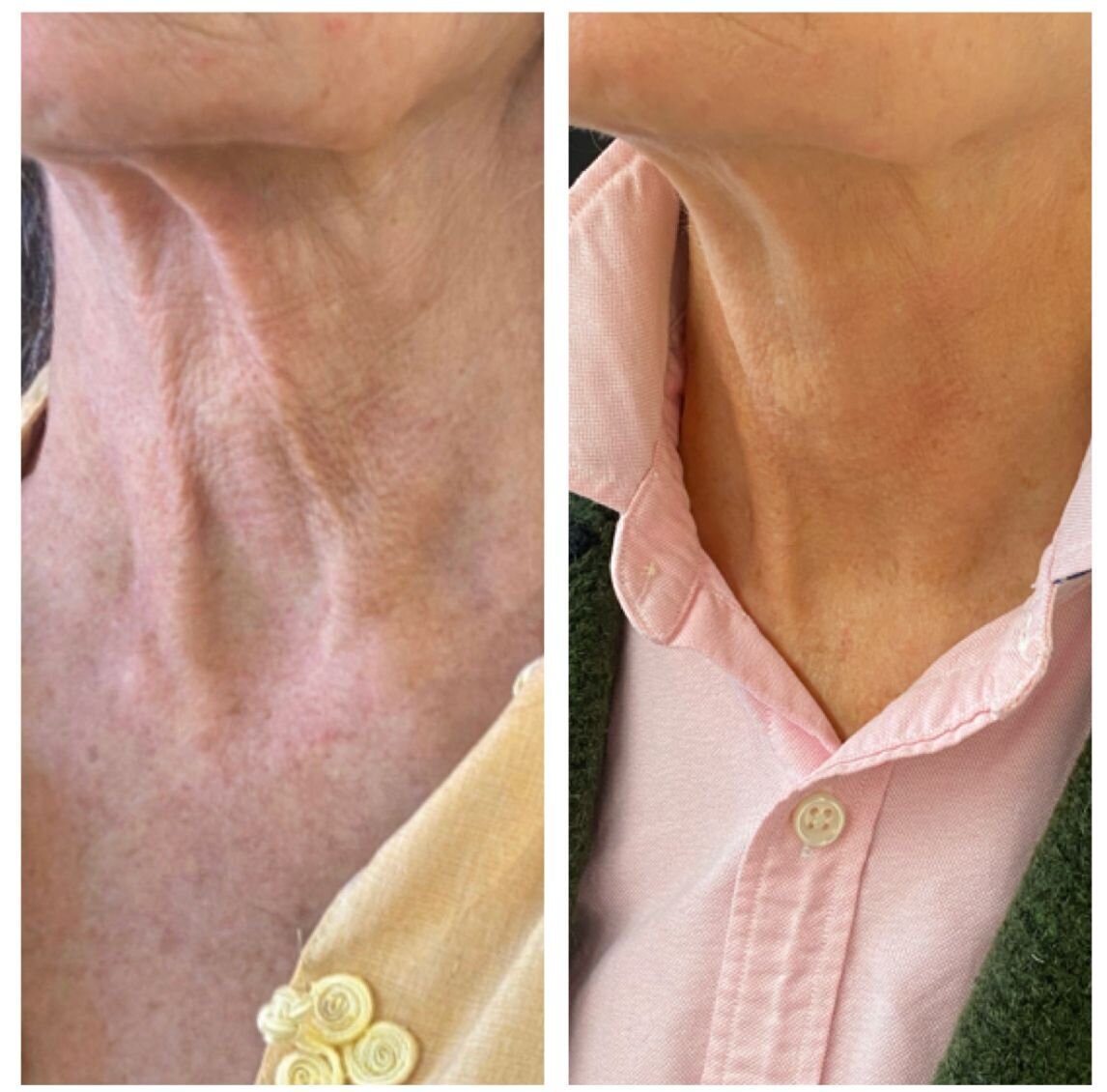 compressed-Hyperdilute-Radiesse-brand-and-before-after-13