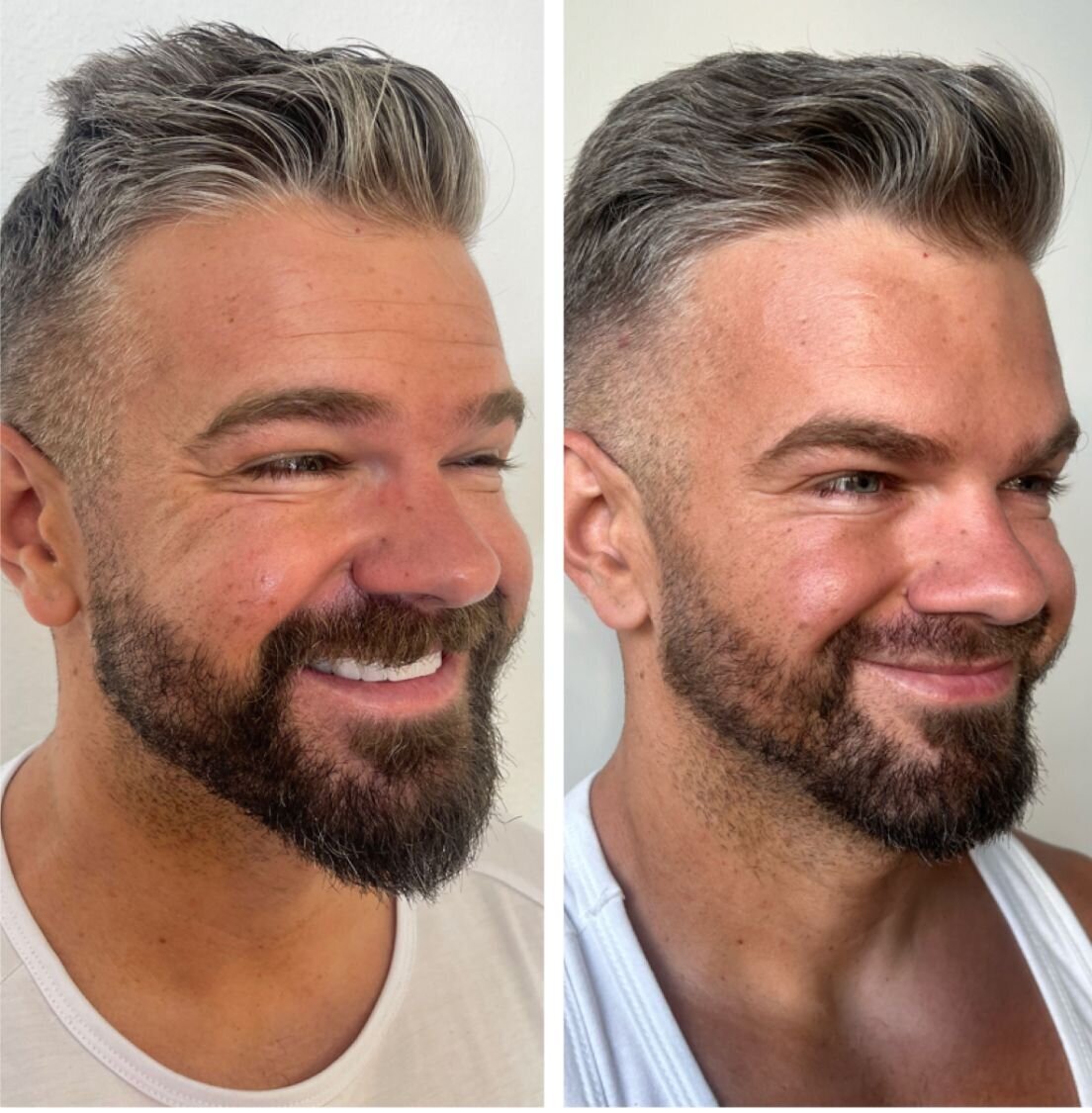 compressed-Neuromodulator-before-after-22