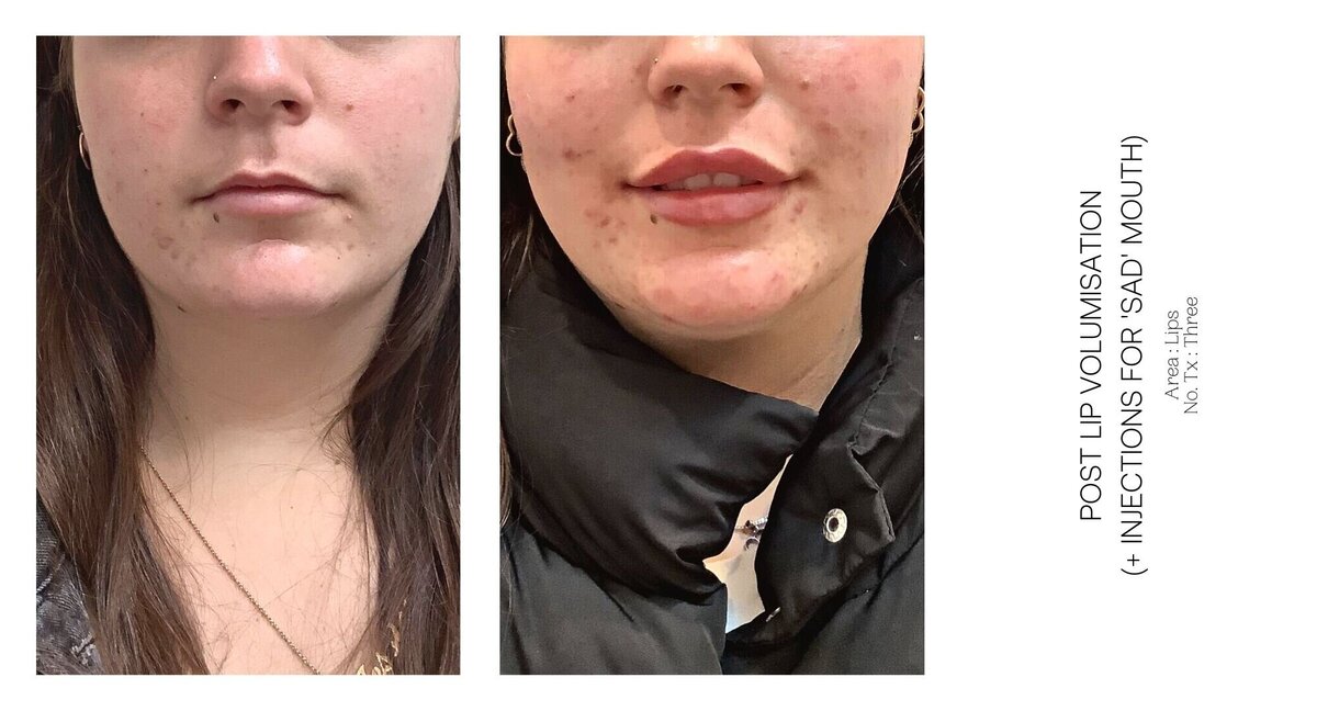 Best South Coast Lip Injection Before and After 50