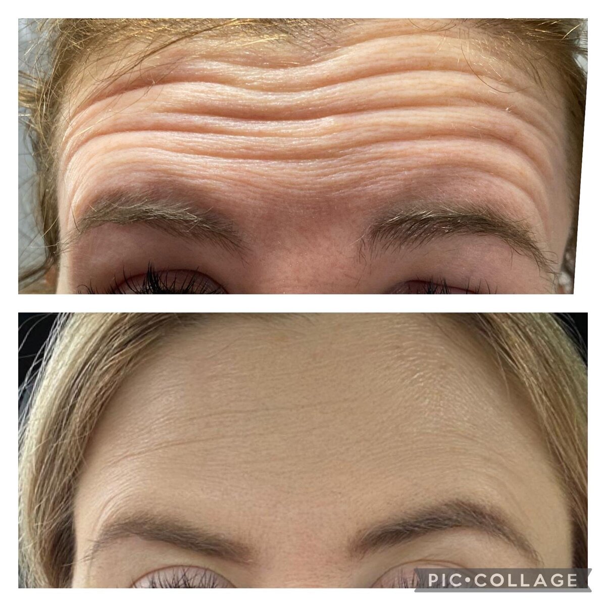 antiwrinkle injections in norwich based clinic aesthetic practitioner