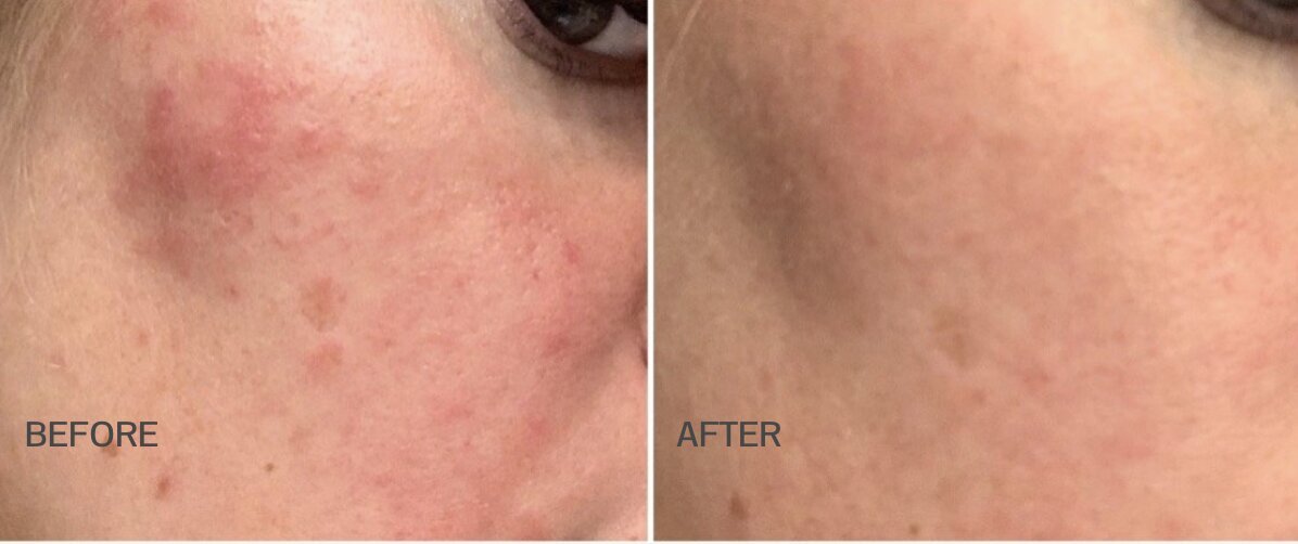 co2lift-pro-carboxytherapy-before-after-2