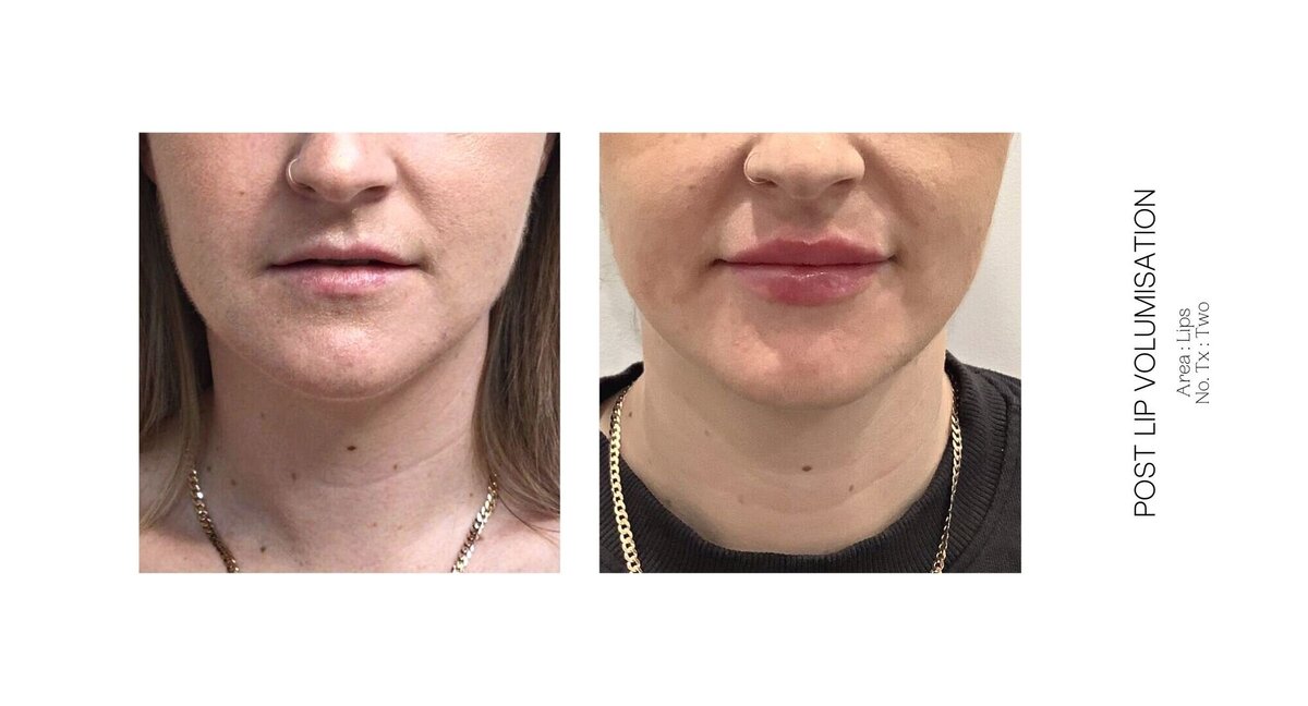 Best South Coast Lip Injection Before and After 33
