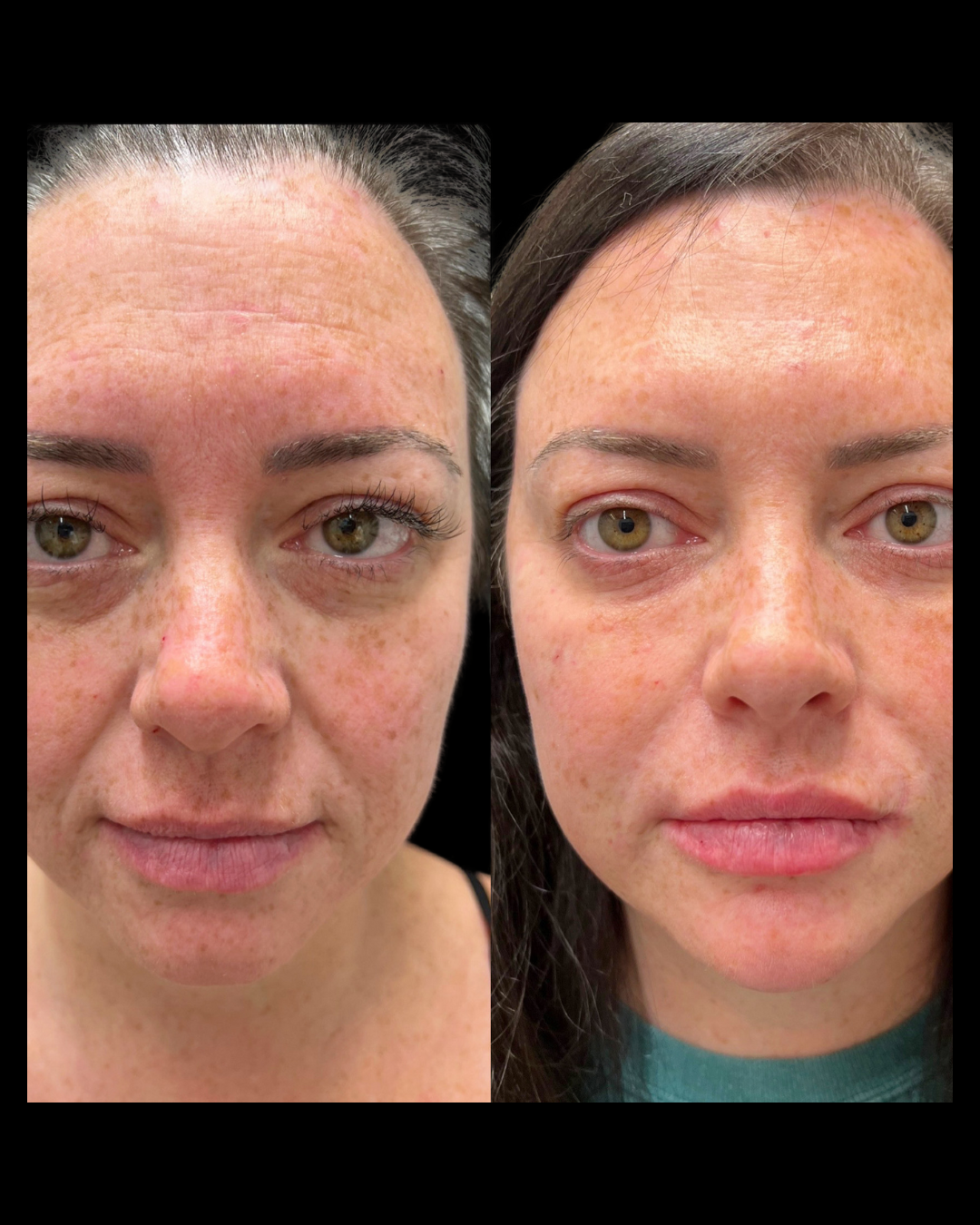 Before-and-after results from facial balancing treatments at Maxwell Aesthetics in Salem, Oregon, including Botox, dermal fillers, lip enhancements, and lower face rejuvenation—designed to enhance natural symmetry and restore youthful contours.