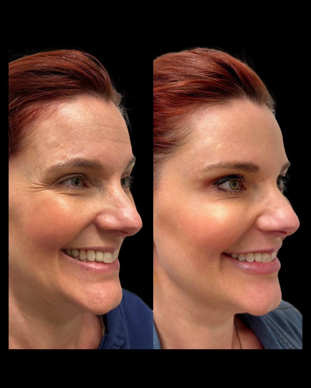 Before-and-after results from facial balancing treatments at Maxwell Aesthetics in Salem, Oregon, including Botox, dermal fillers, lip enhancements, and lower face rejuvenation—designed to enhance natural symmetry and restore youthful contours.