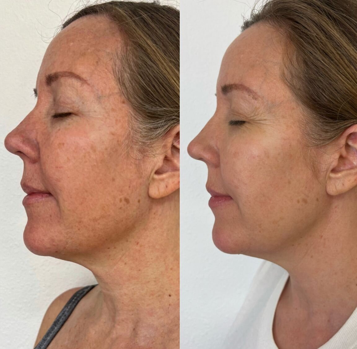 compressed-missing-laser-images-before-after-01