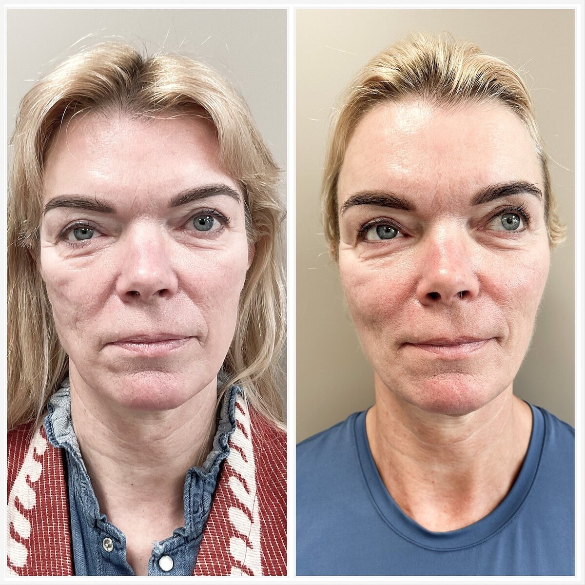 Liquid facelift door Lizenka Adriaanse cosmetisch arts Rotterdam2