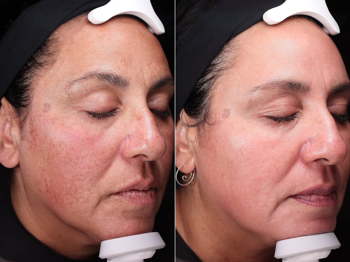 Allure AZ_sun-spot-removal-flagstaff-medspa_0037