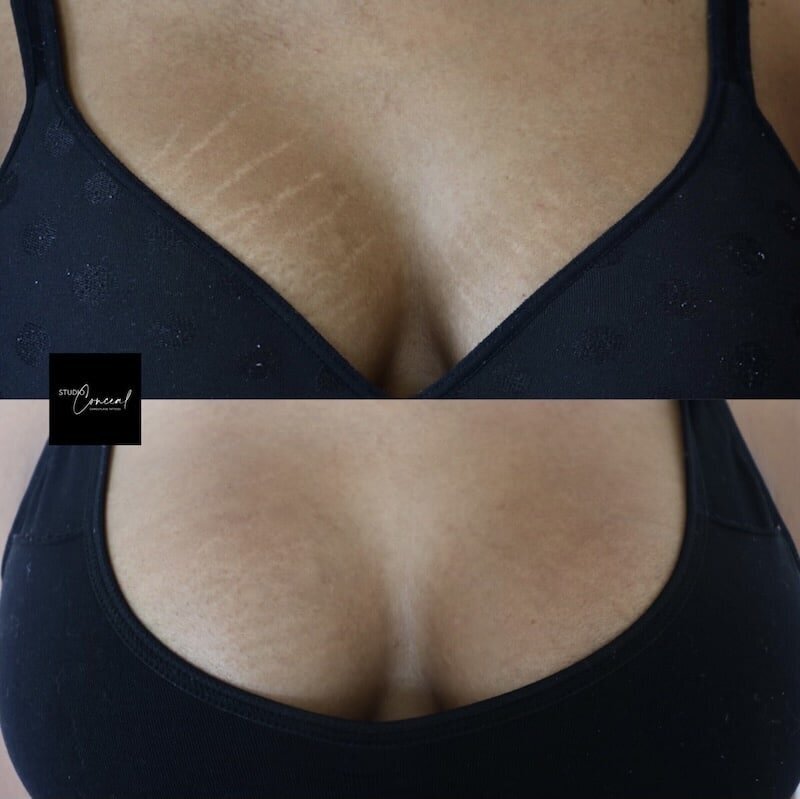 arizona-stretch-mark-removal-tattoo