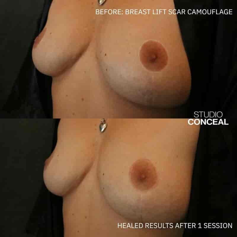 breast lift explant scar