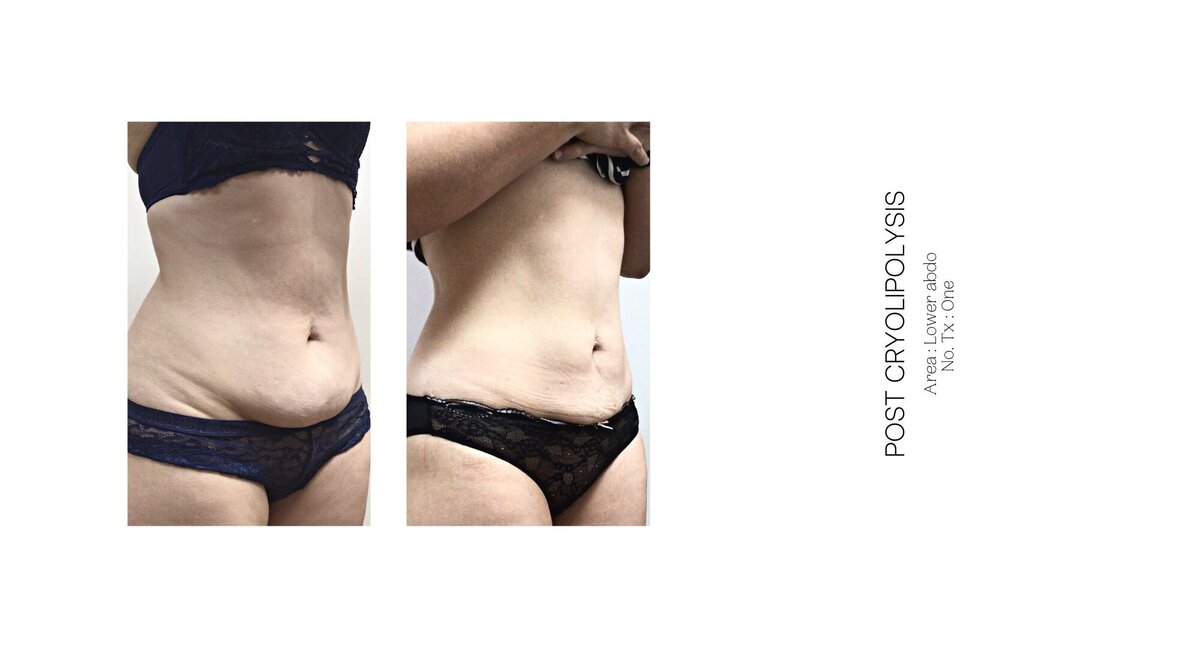 Cryolipolysis Lower Stomach Before and After 1