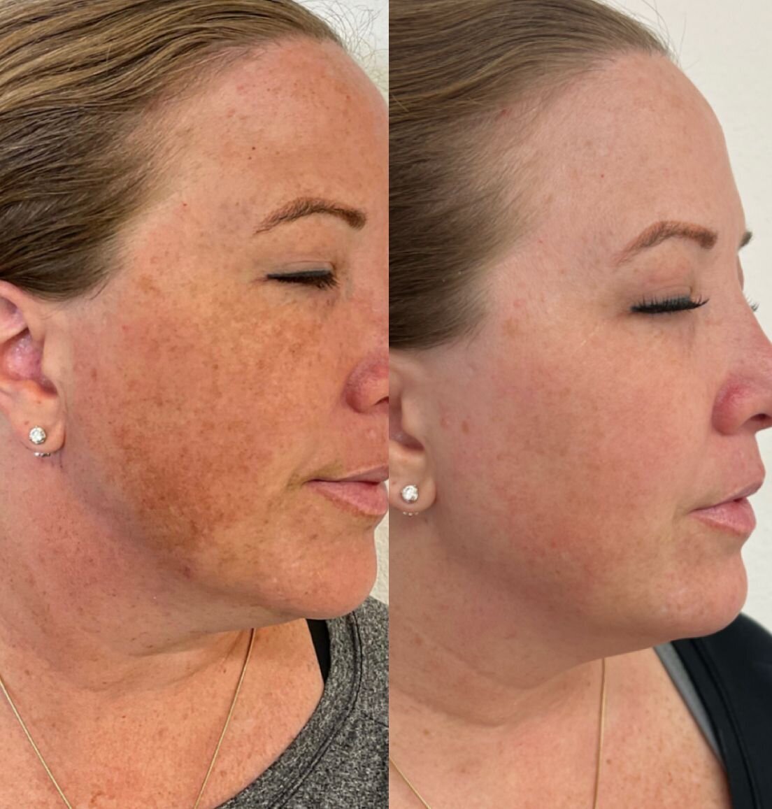compressed-missing-laser-images-before-after-07
