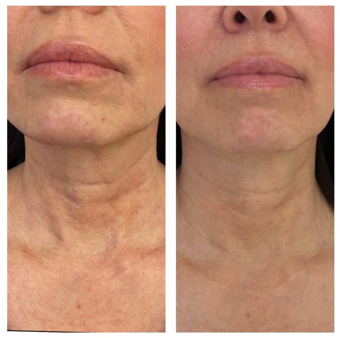 compressed-Hyperdilute-Radiesse-brand-and-before-after-01