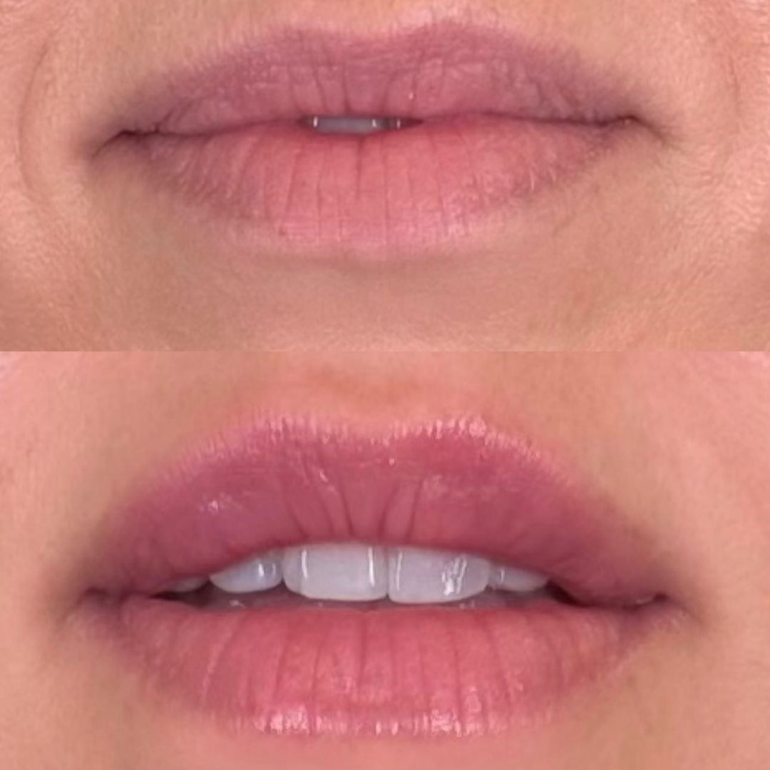 Sean Lip Filler Injectables