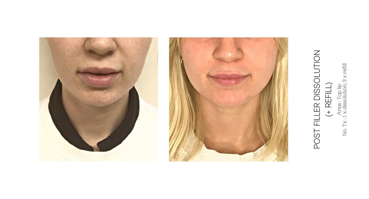 Top Lip Filler Dissolve Before and After 8