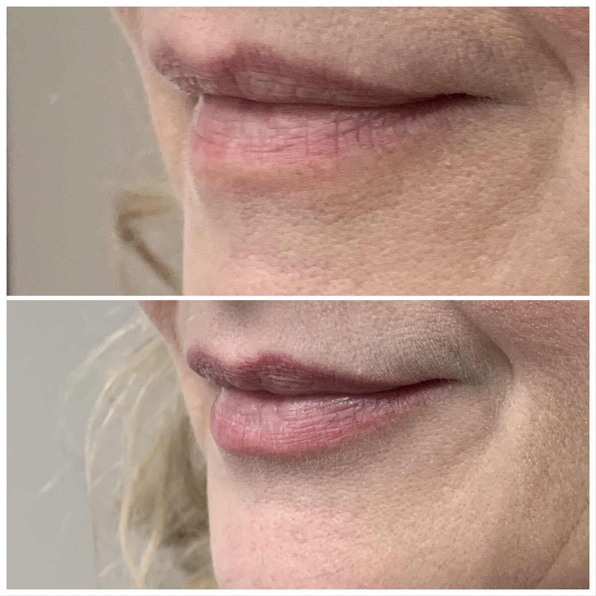 Lipfillers Rotterdam cosmetisch arts Lizenka Adriaanse
