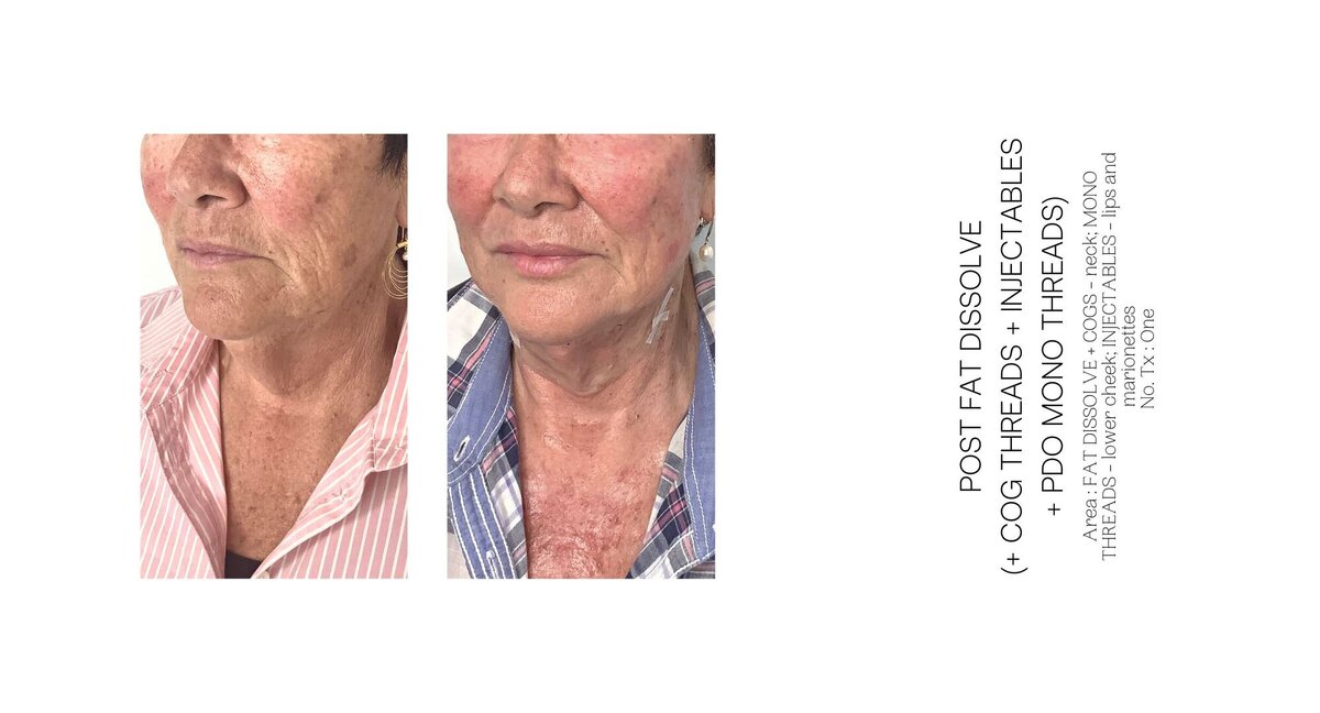 Threads Injectables and Fat Dissolve Before and After