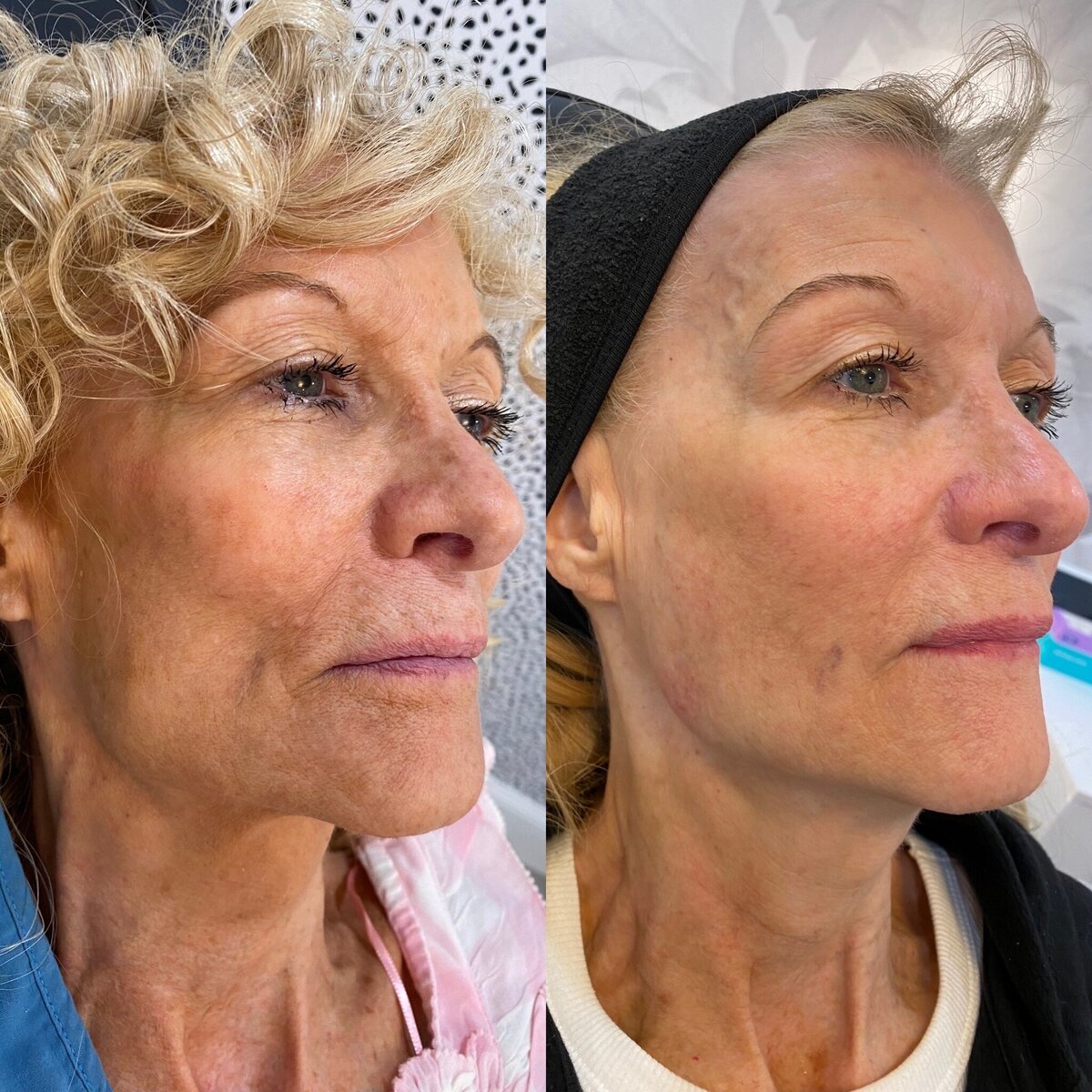 BalancedBeautyBotoxWestwood9