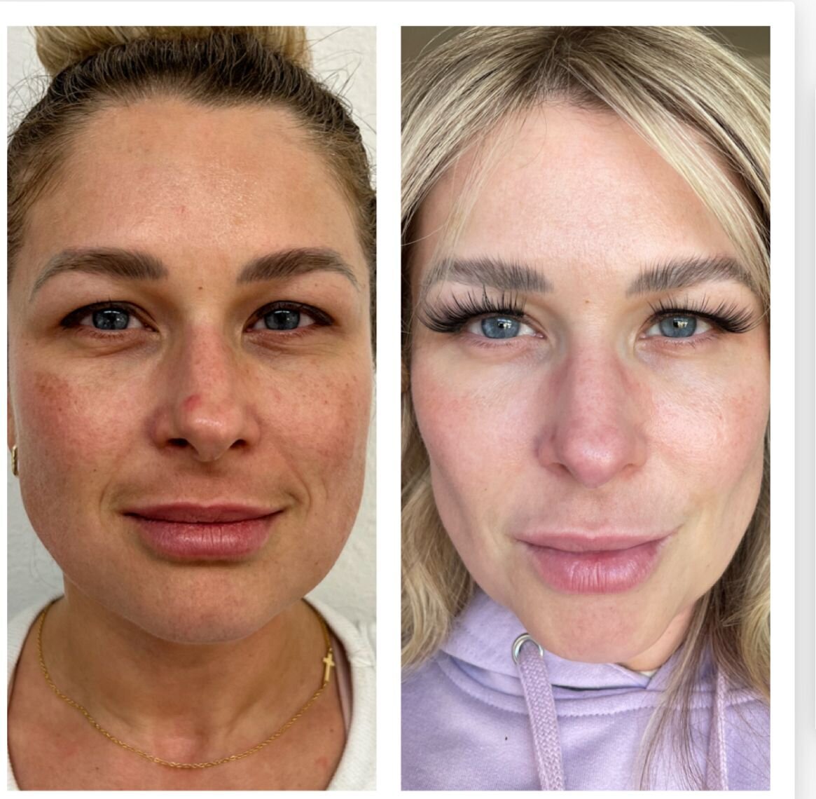 compressed-Moxi- BBL-before-after-14