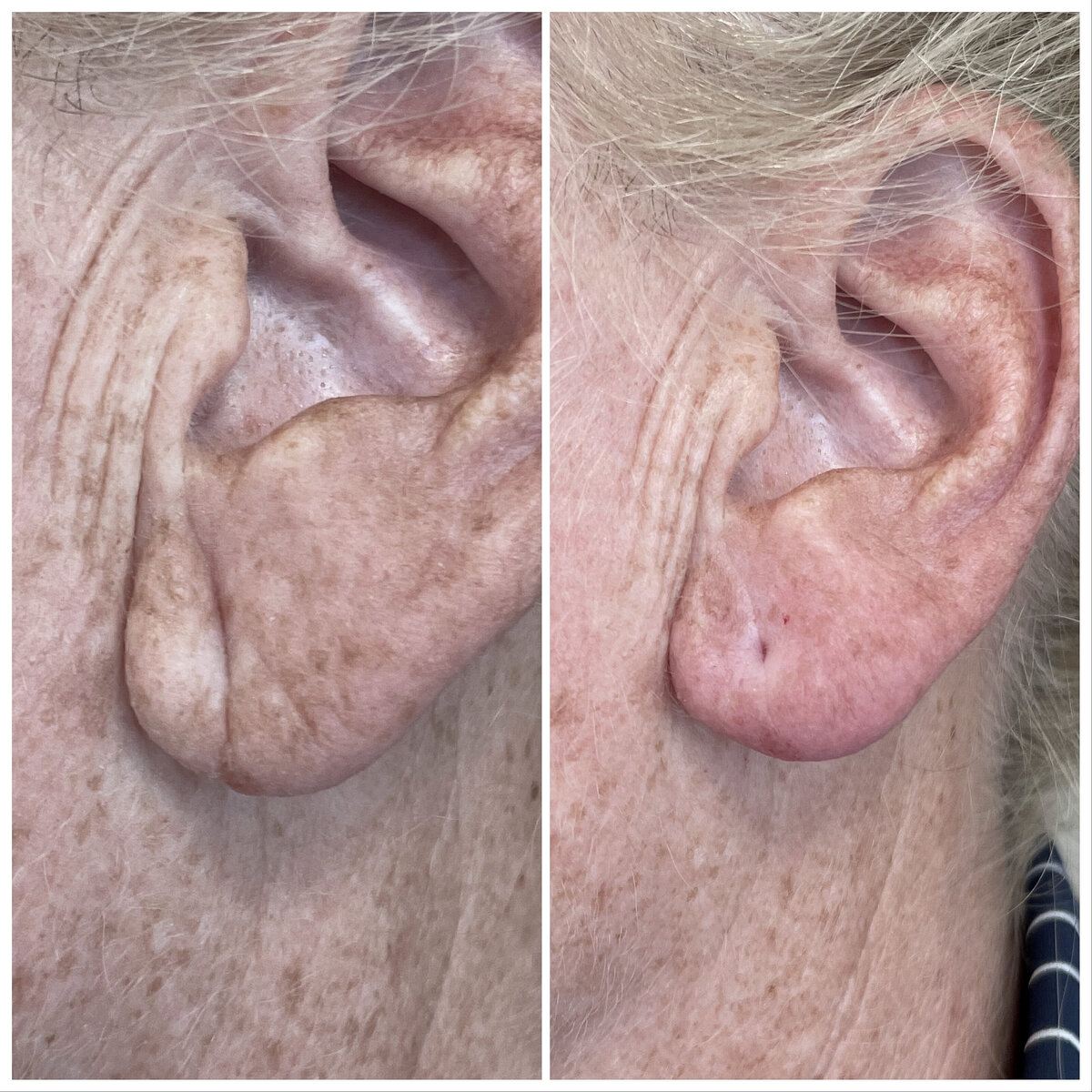 Fillers oorlellen Rotterdam