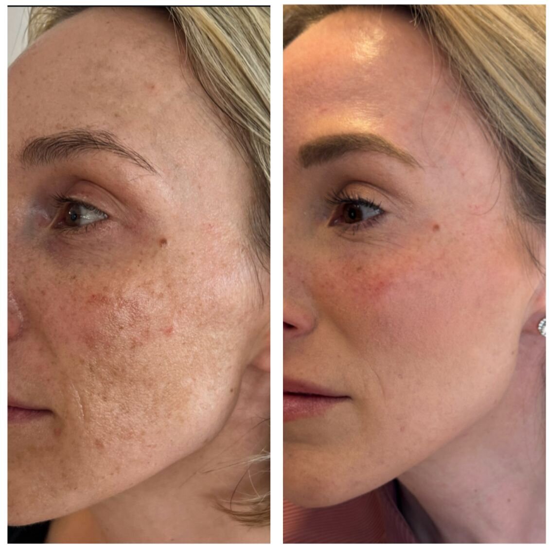 compressed-Moxi- BBL-before-after-10