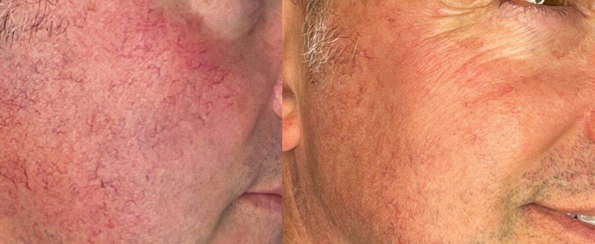 one IPL treatment for facial blood vessels using the Candela Nordlys PR530 handpiece
