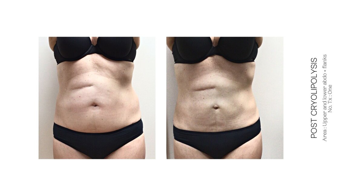 Cryolipolysis Stomach Before and After 7