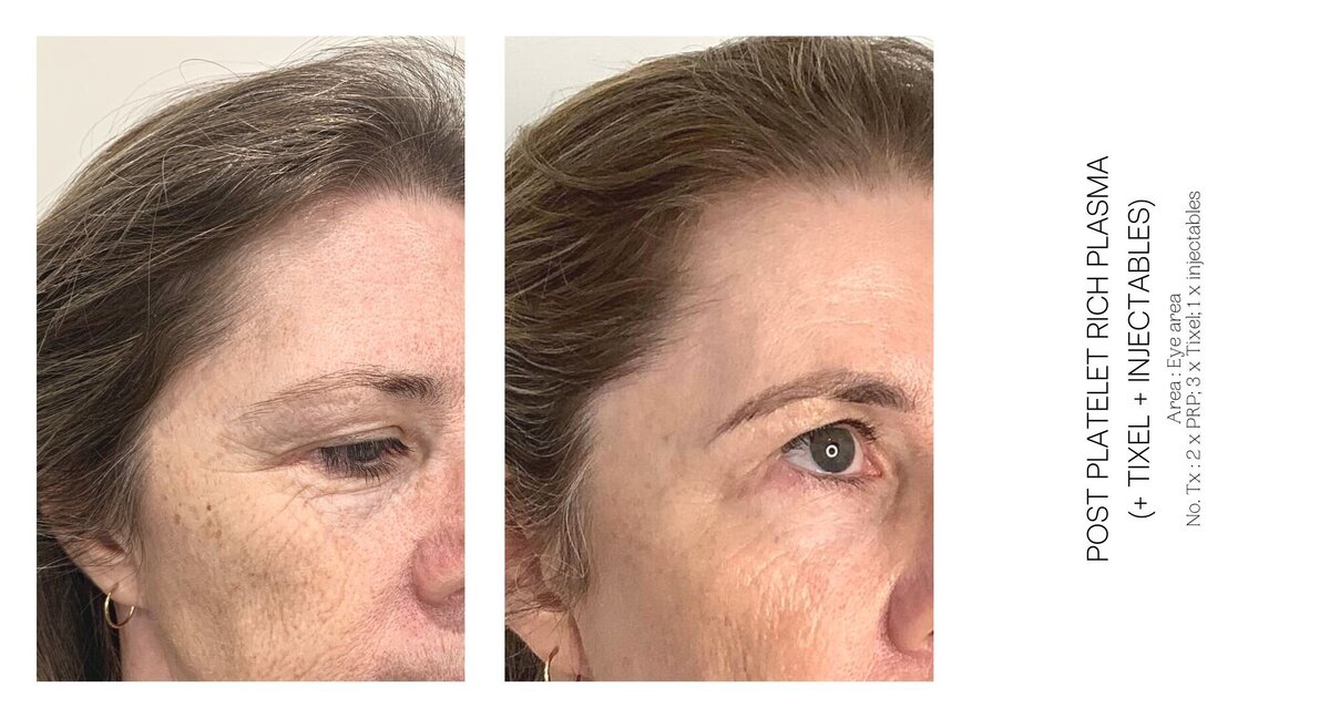 PRP Under Eye Before and After 2