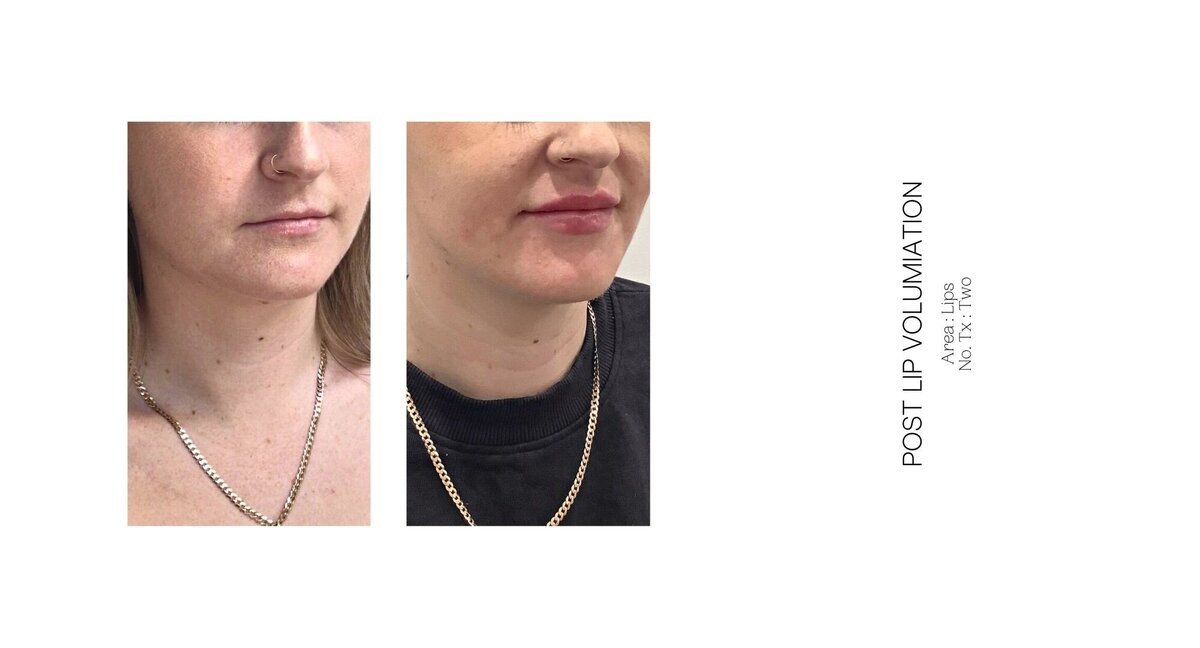 Best South Coast Lip Injection Before and After 24