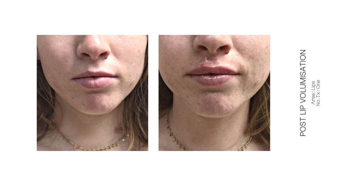 Best South Coast Lip Injection Before and After 40