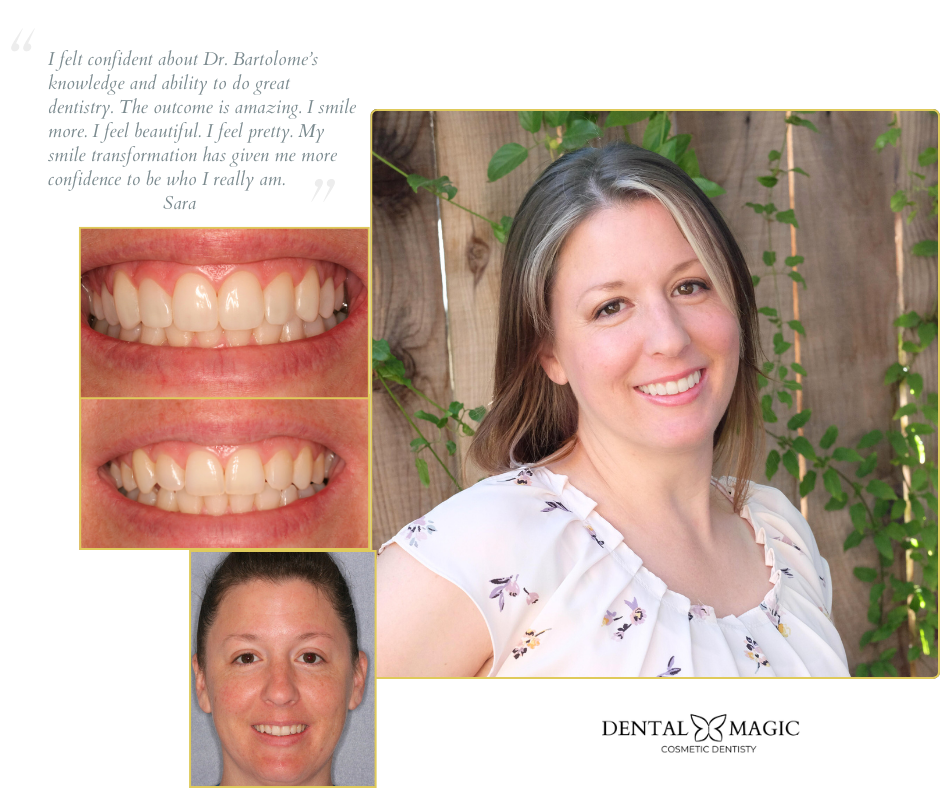 Cosmetic Tooth Bonding