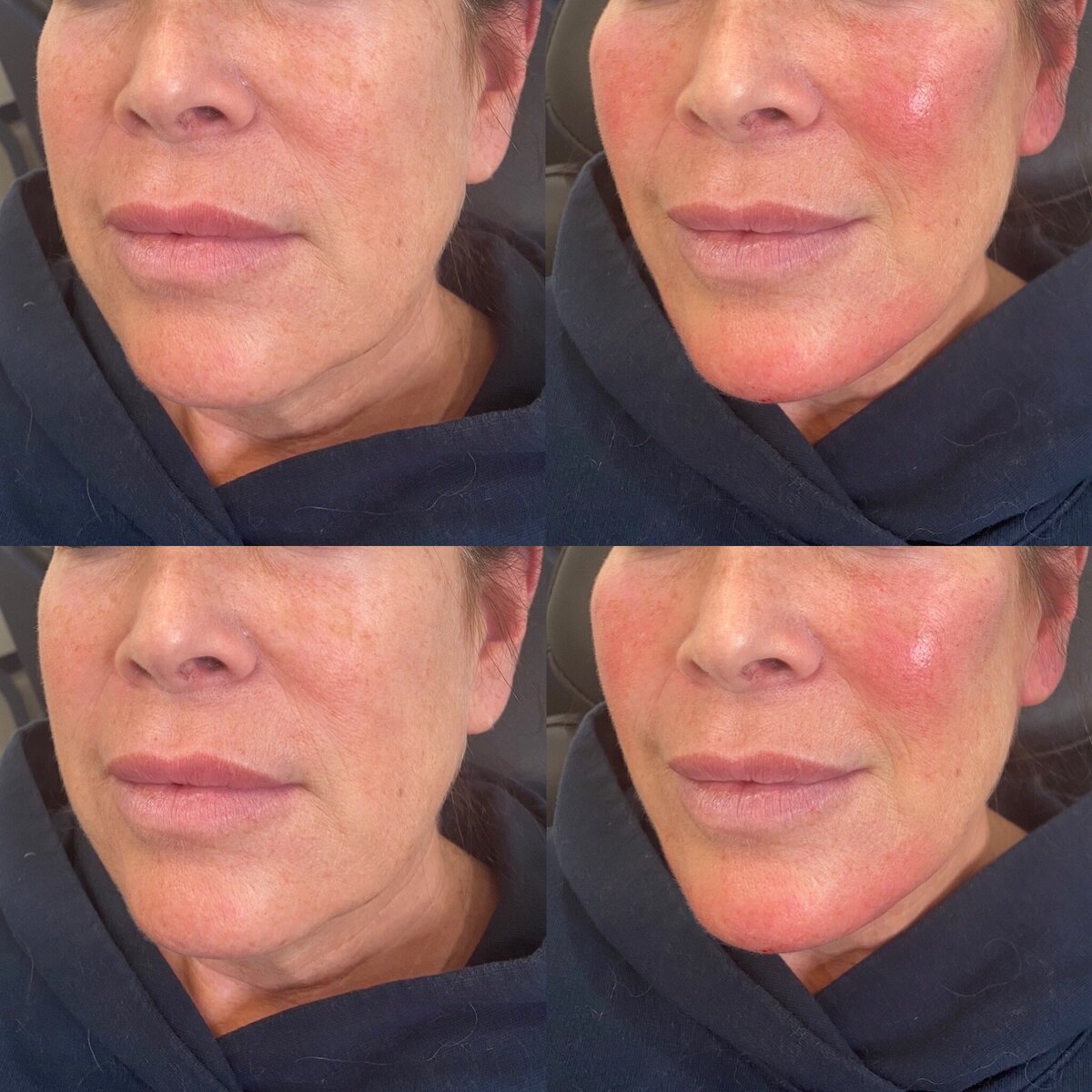 BalancedBeautyBotoxWestwood8